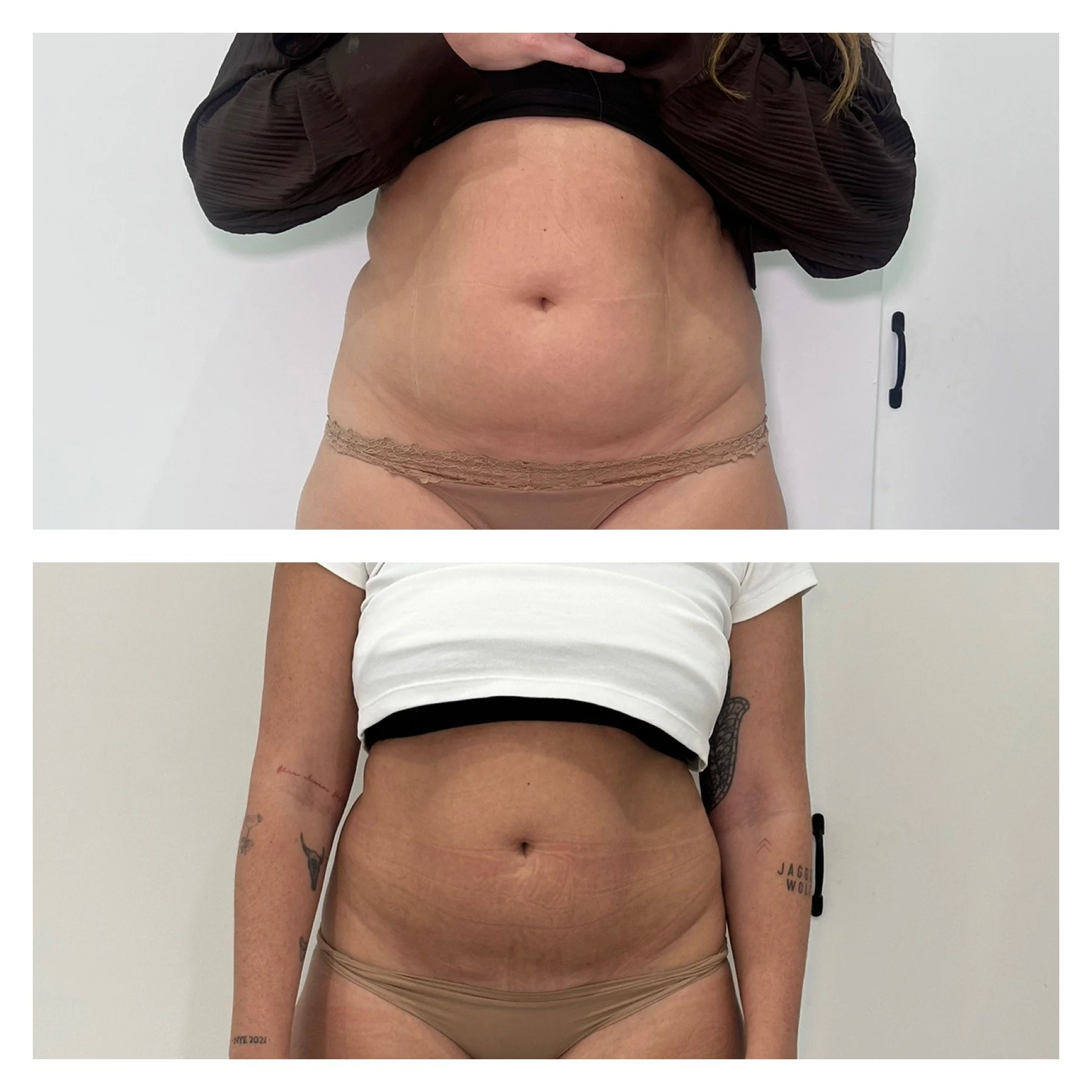Fat freezing treatment in progress