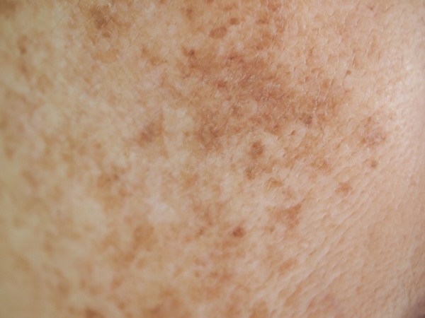 Pigment & Sun Damage