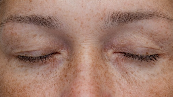 Freckles