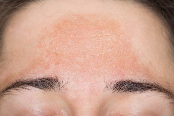 Uneven Tone & Dullness