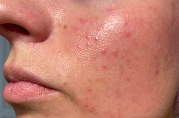 Rosacea