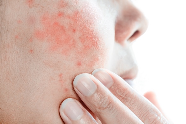 Facial Redness & Flushing