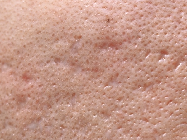 Acne Scarring