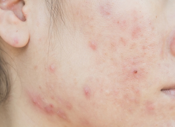 Oily & Congested Skin