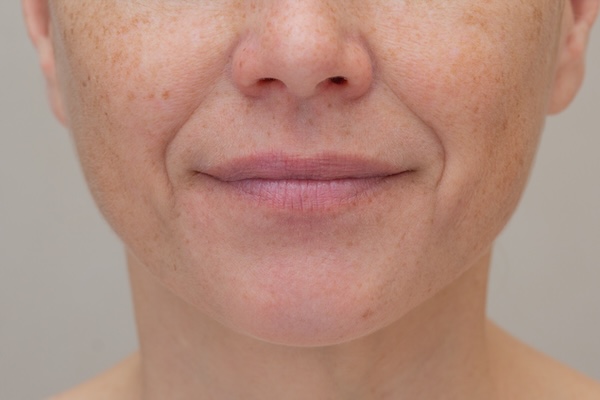 Cheek Lift & Mid-Face Volume