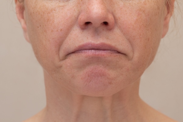 Smile Lines (Nasolabial), Marionette Lines & Folds