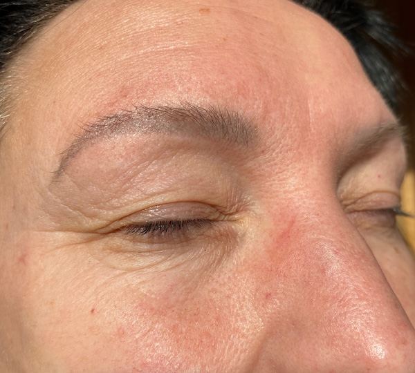 Fine Lines & Wrinkles