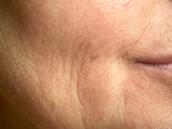 Dehydrated Skin