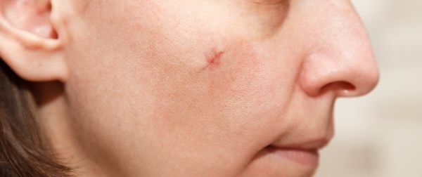 Scarring (Non-Acne)