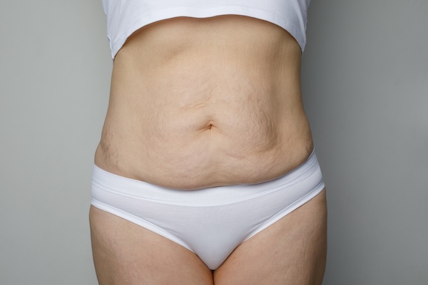Stubborn Fat – Stomach, Flanks, Thighs, Arms