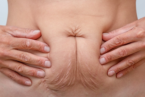 Loose / Sagging Body Skin