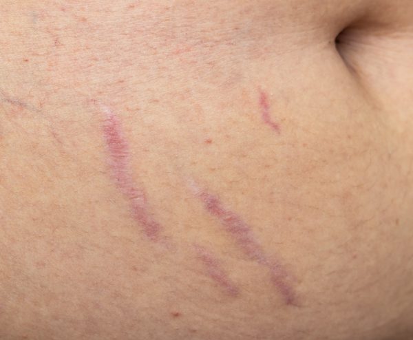 Stretch Marks