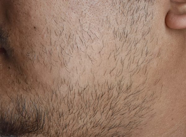 Patchy / Sparse Beard