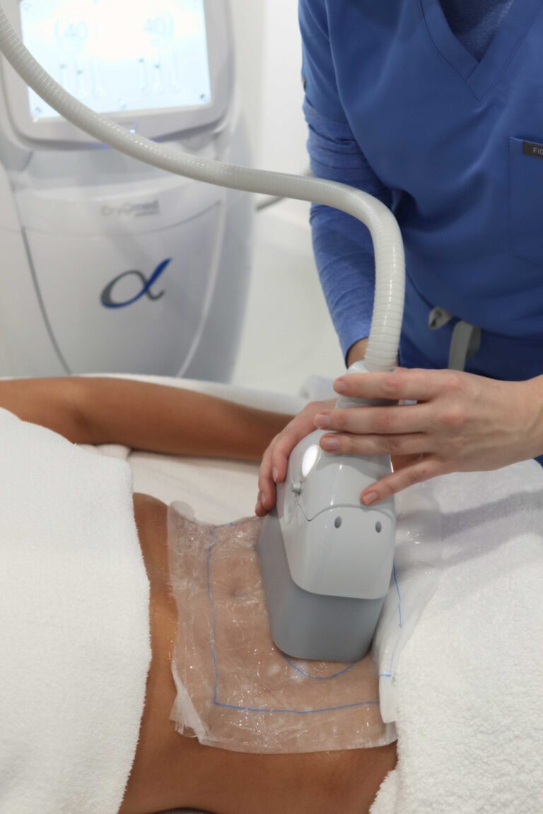 Clatuu Alpha fat freezing treatment on the abdomen at Shape of You Perth