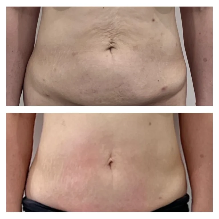 Before and after two HIFU sessions on the stomach