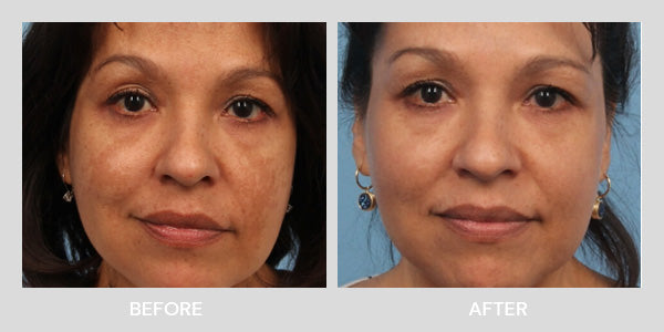 Laser Skin Renewal before and after at Shape of You