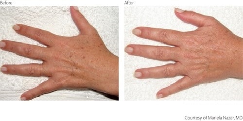 Pigmentation before and after at Shape of You