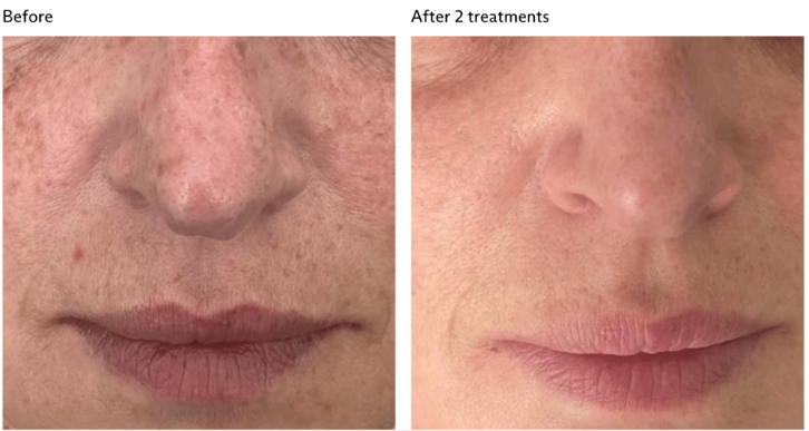 Skin Correction before and after at Shape of You
