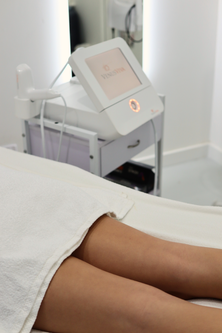 Venus Viva NanoFractional RF set up for a stretch mark treatment at Shape of You Perth