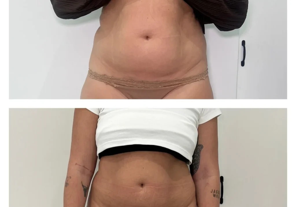 fat-freezing-cover
