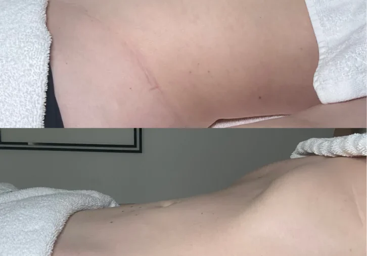 lymph-before-after