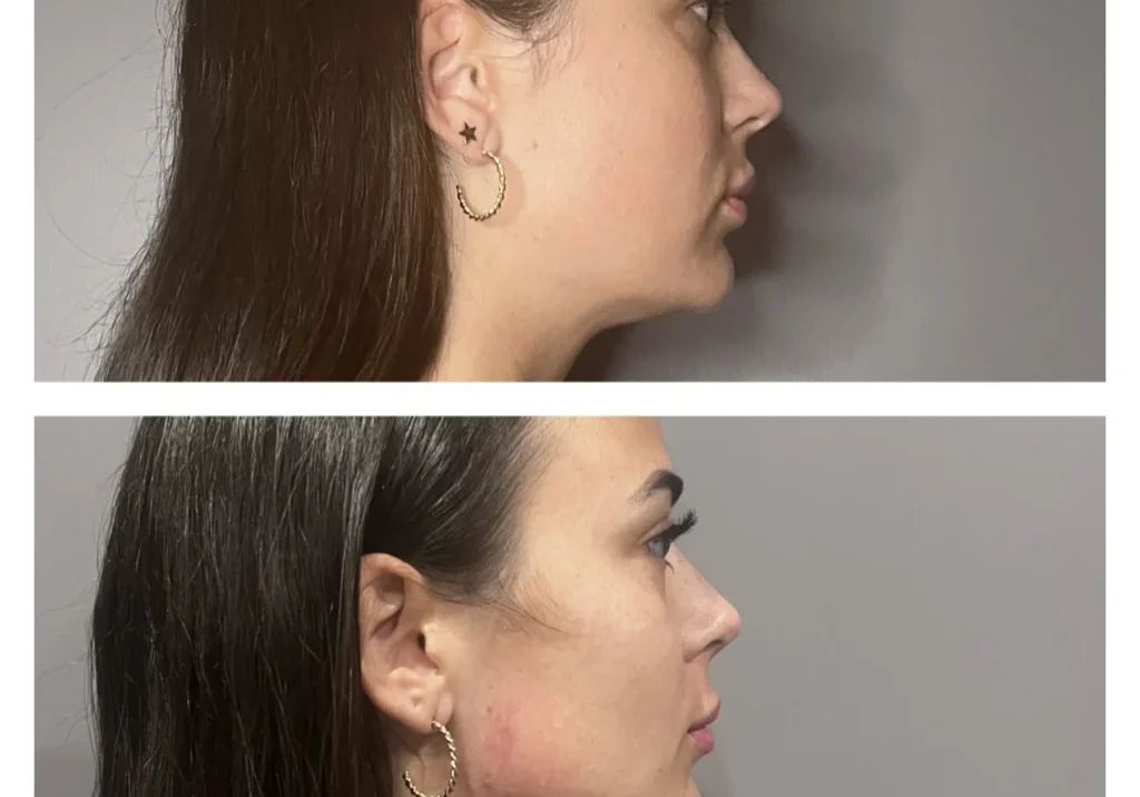 result-01-rf-jaw-contour-3tx