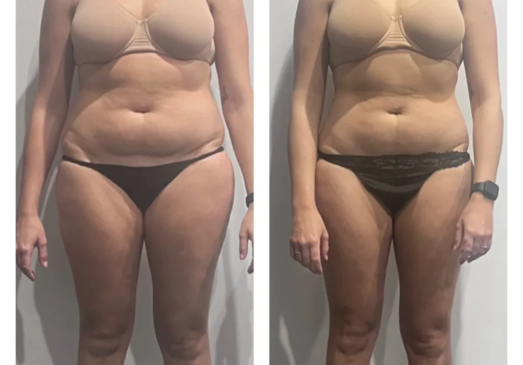 result-03-fat-freezing-3tx