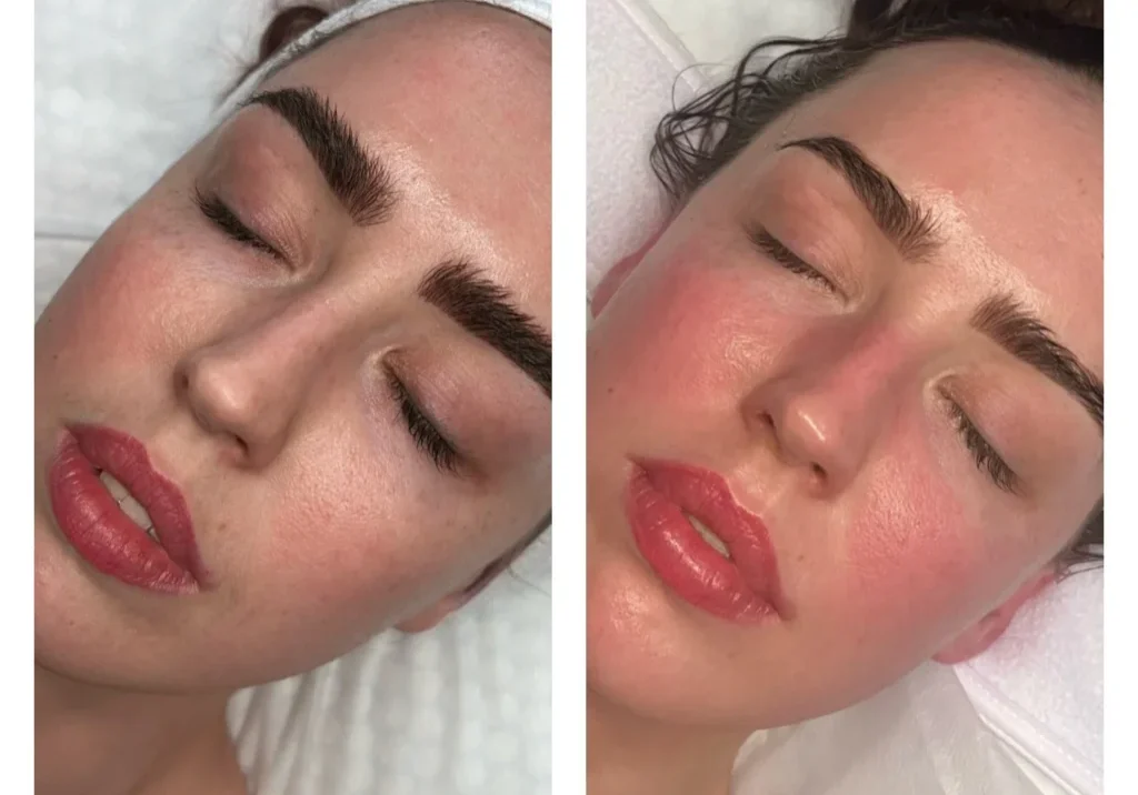 result-08-dermaplaning-peel