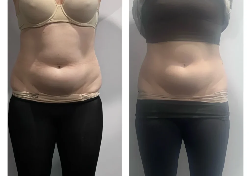 result-10-fat-freezing-2tx-c