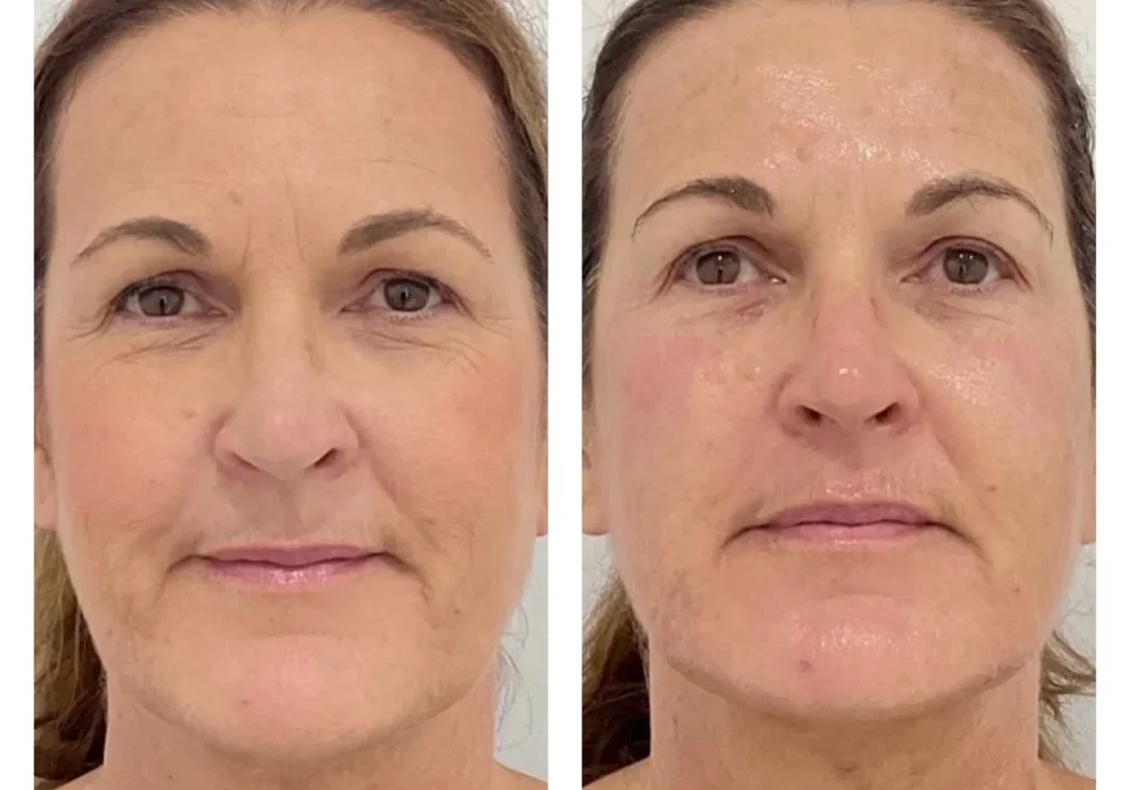 result-13-notox-facial-a