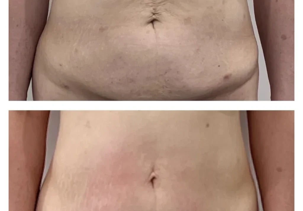 Before and after two HIFU sessions on the stomach