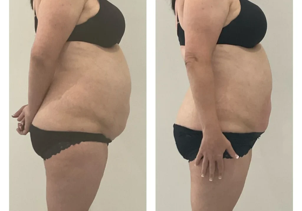 result-18-trim-tighten-tone-1tx