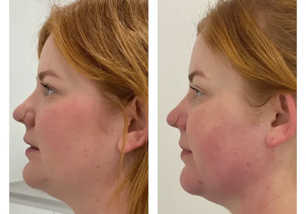 result-20-rf-jaw-contour-3tx-b