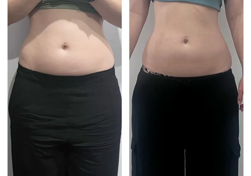 result-21-fat-freezing-2tx-e