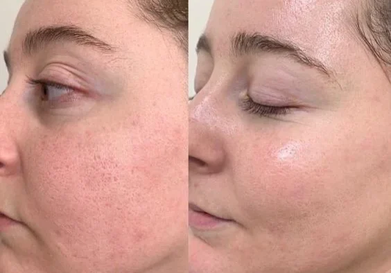 skin-needling-before-after